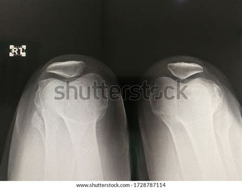 Skyline View Xray Shows Body Patella Stock Photo 1728787114 | Shutterstock