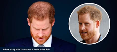 All About Prince Harry Hair Transplant - Smile Hair Clinic