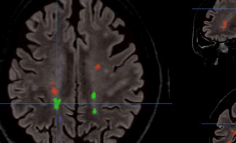 DEEP-LESIONBRAIN: software to automatically segment white matter ...