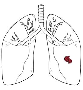 Benign Lung Tumour Treatment Singapore | Neumark Thoracic Centre