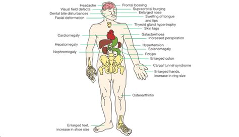 Acromegaly Disease