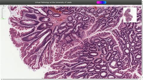 Tubular Adenoma Histology