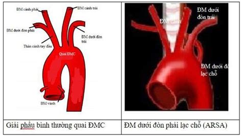 How is ARSA identified on fetal ultrasound? | Vinmec