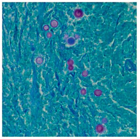 PAS fungal stain showing evidence of variably sized budding yeast. ×600.