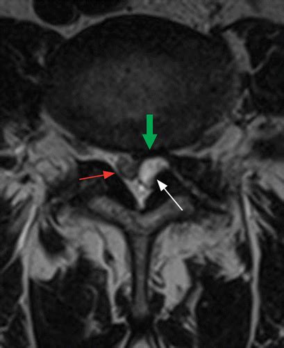 Ligamentum Flavum Hypertrophy Mri