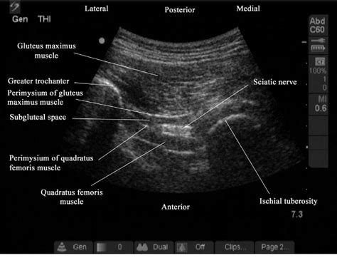 Figure 2 from Ultrasound-guided sciatic nerve block: description of a new approach at the ...