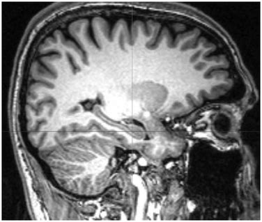 In vivo evaluation of cortical thickness with magnetic resonance ...