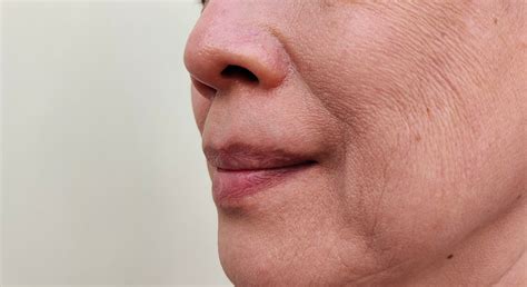 Understanding What Causes Skin Wrinkles | Laser Skin Solutions