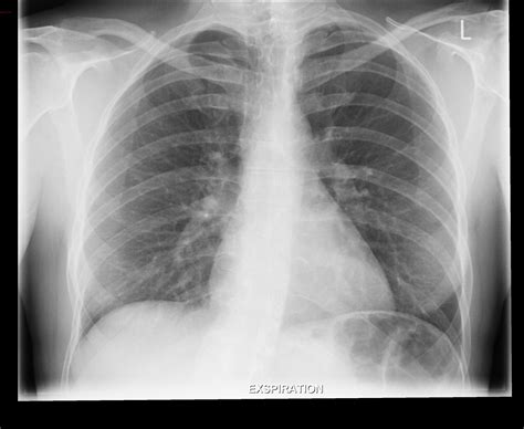 Chest Xray In Pneumothorax Images - vrogue.co