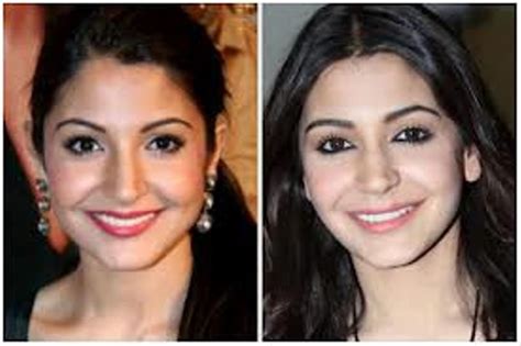 Anushka Sharma’s Lip Job, Hmmmmm! | Showbiz Bites | Plastic surgery ...