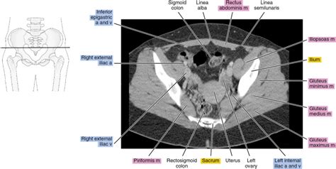 CT of the female pelvis | Radiology Key