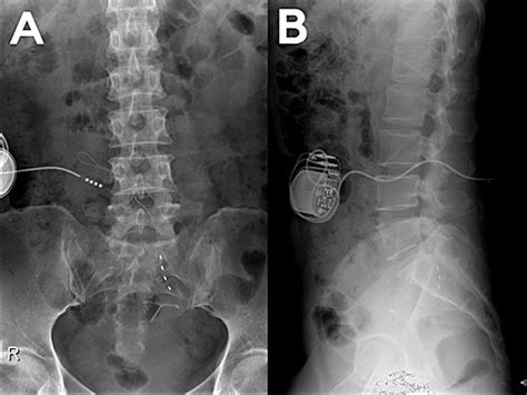 Sacral Nerve Stimulation for the Treatment of Sacroiliac Joint Dysfunction: A Case Report ...