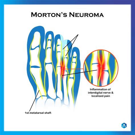 Mortons Neuroma (1) | Dr. Abbie Clinics