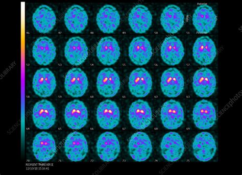 Dopamine transporter-PET brain scans - Stock Image - C056/6177 - Science Photo Library