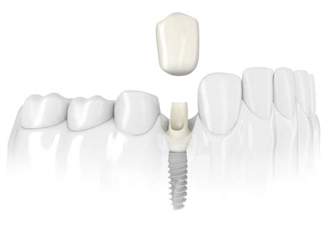 Single Tooth Dental Implants - Capital Dental Clinic Fredericton