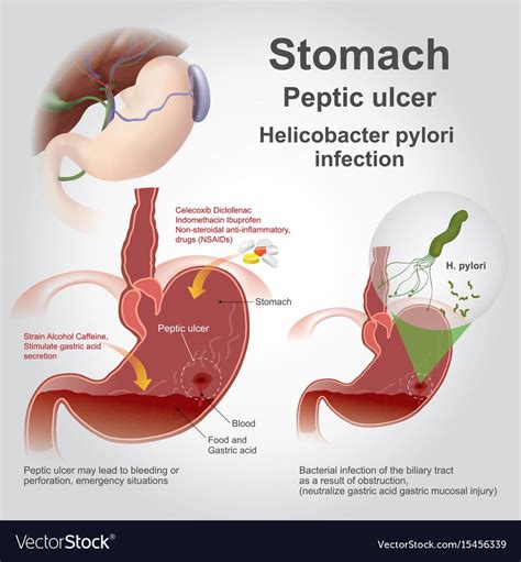 Ulcer symptoms – Artofit