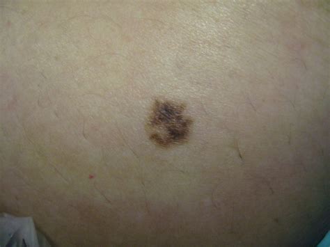 The Armchair Dermatologist: Melanoma in situ