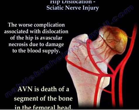 Hip Dislocation- Sciatic Nerve Injury — OrthopaedicPrinciples.com