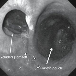 Upper GI series showing that the gastrogastric fistula has been closed. | Download Scientific ...