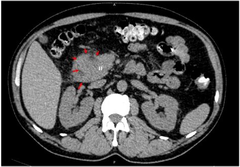 Diagnostics | Free Full-Text | Groove Pancreatitis—Tumor-like Lesion of the Pancreas