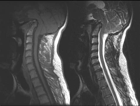 platybasia basilar invagination