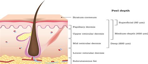 Chemical peels: A review of current practice - O'Connor - 2018 - Australasian Journal of ...