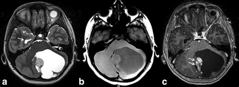 Neuroimaging of pediatric posterior fossa tumors including review of the literature - Poretti ...