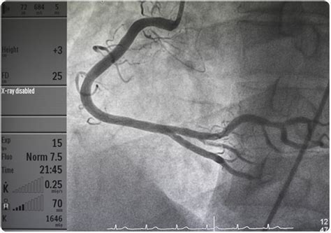 Angiogram