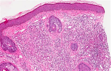 Granuloma faciale (eosinofilicum)