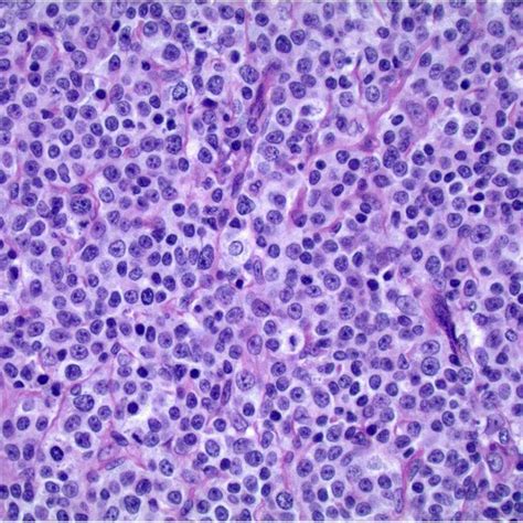 H&E staining of the same lymph node at higher power (× 400 ...