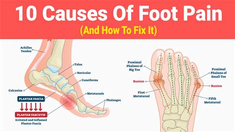 What Causes Sharp Pain On The Top Of Your Feet - Printable Templates Protal