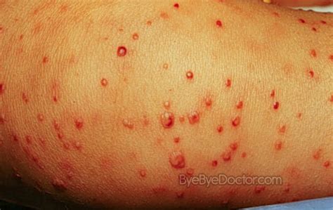 Staph Infection – Pictures, Symptoms, Causes, Treatment