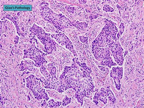 Qiao's Pathology: Invasive Ductal Carcinoma in Male Breast… | Flickr