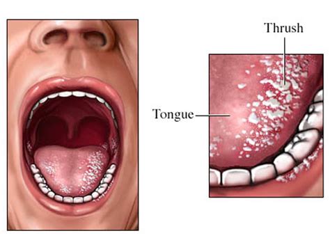 Oral Thrush Infection And The Solution