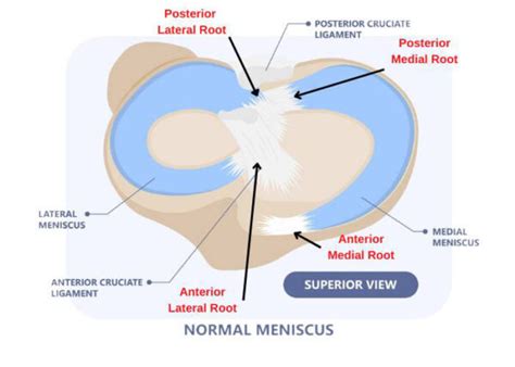 Meniscus Root Tear | Torn Meniscus Specialist | Sugar Land, Pearland, Houston, TX