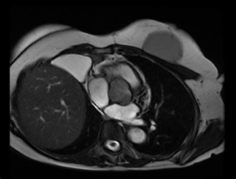 Pericardial Cyst Mri