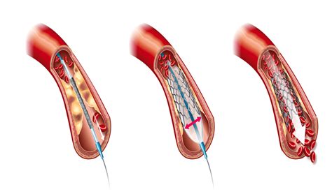 Heart Angioplasty Stent Surgery Procedure in Hyderabad | Dr. Raghu