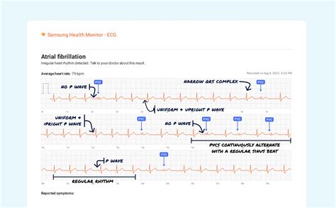 Ventricular Bigeminy Vs. Premature Ventricular Contraction (Couplet) on ...