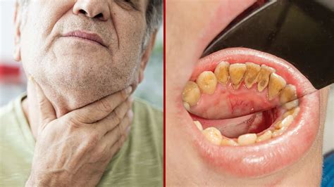 Oncologist Reveals the Causes and Early Signs of Oral Cancer