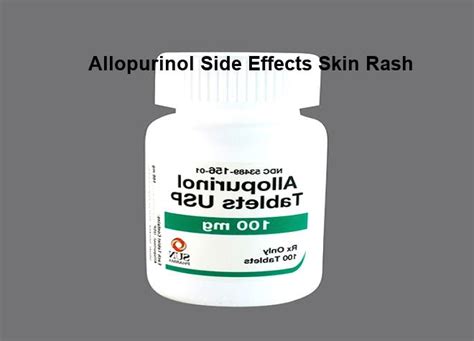 Allopurinol side effects rash, allopurinol side effects rash – 24/7 ...