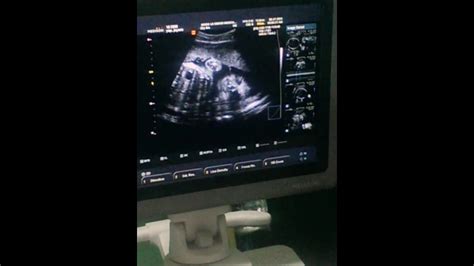 2nd ultrasound (cephalic position) - YouTube