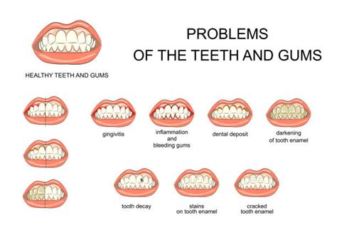 What are the Complications of a Root Canal? | Drjcares Root Canal