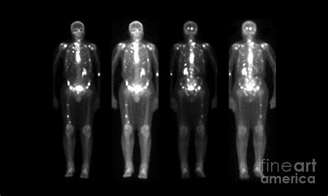 Nuclear Medicine Bone Scan Photograph by Medical Body Scans