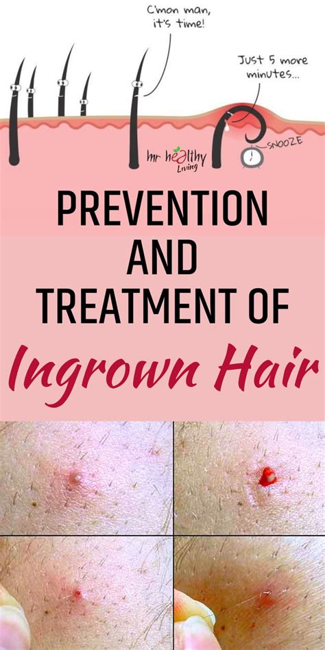 Pin by Ingrown Hair Neck on Medium Length Hair | Ingrown hair treatment ...