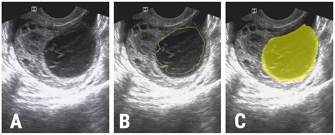 Transvaginal Ultrasound Ovarian Cysts