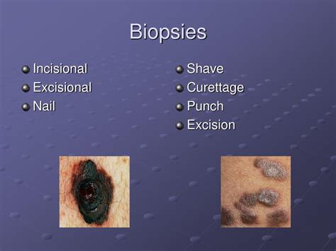 PPT - Biopsy Techniques PowerPoint Presentation, free download - ID:6574308