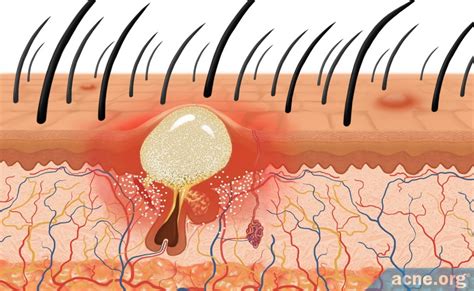 Scalp Acne - Info & Treatment Options - Acne.org