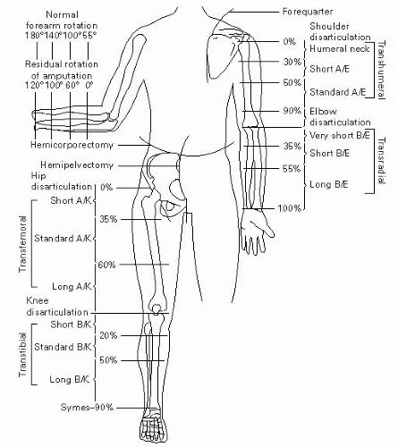 Amputation/Prosthetics | Musculoskeletal Key