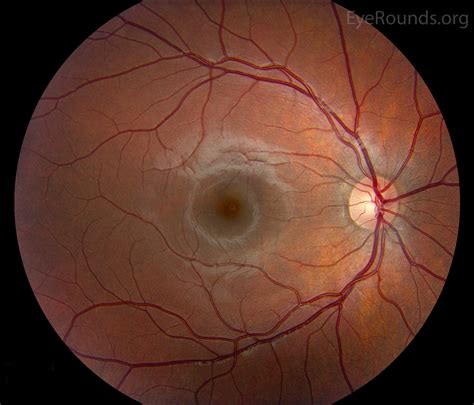 Atlas Entry - Normal fundus (child)