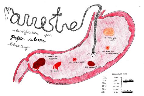 Peptic ulcer bleeding – Forrest classification – Arztlogy